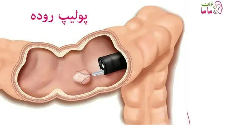 پولیپ روده