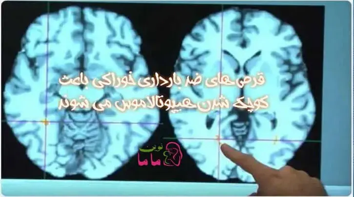 قرص های ضدبارداری خوراکی باعث کوچک شدن هیپوتالاموس می شوند
