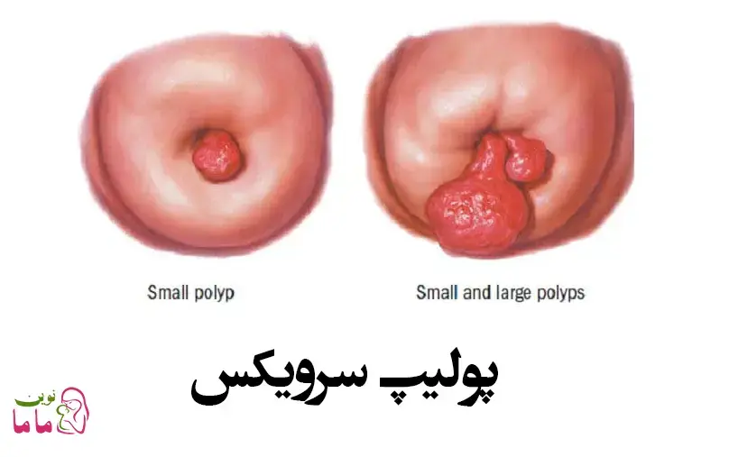پولیپ سرویکس 