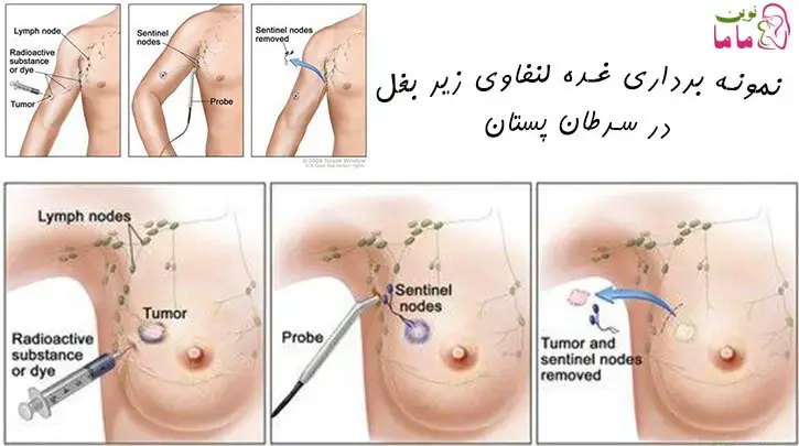 نمونه برداری غده لنفاوی زیر بغل در سرطان پستان