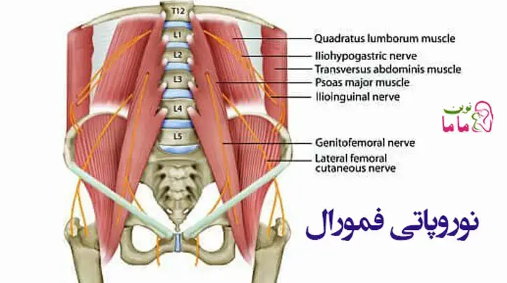 نوروپاتی فمورال 