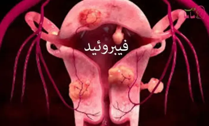  اولیپریستال ممکن است کیفیت زندگی و شدت علائم را در زنان مبتلا به فیبروم رحمی بهبود بخشد.