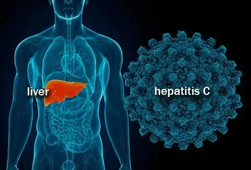 آزمایش عفونت HCV باید شامل آزمایش FDA برای آنتی بادی ضد HCV باشد