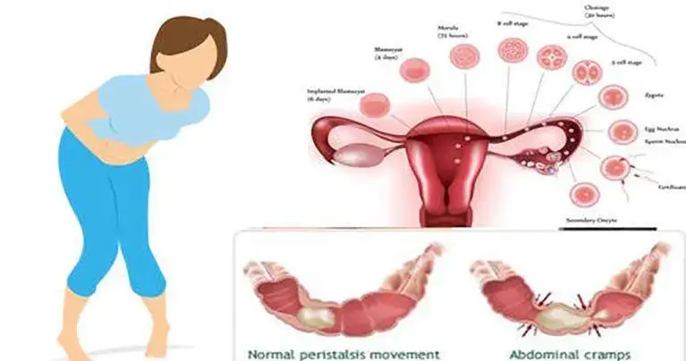 دیسمنوره به علائم قاعدگی دردناک گفته می شود. این را می توان به دو دسته گسترده تقسیم کرد: