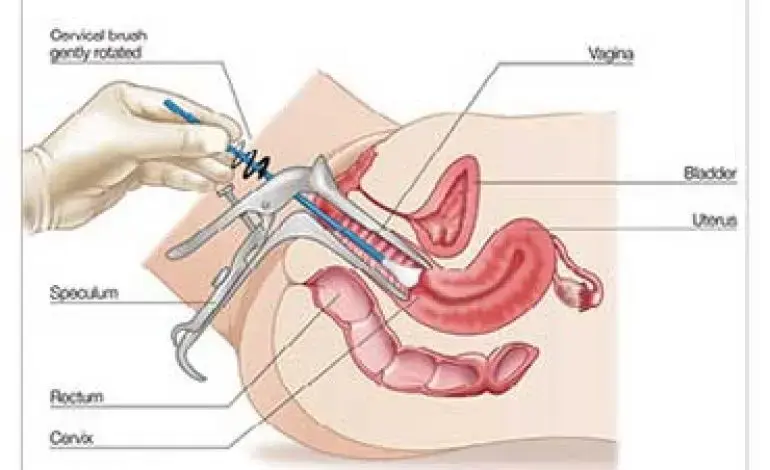 انواع HPV کم خطر - HPV نوع 6 و 11 می تواند باعث زگیل تناسلی شود و از نوع کم خطر است زیرا به ندرت باعث سرطان دهانه رحم می شود.