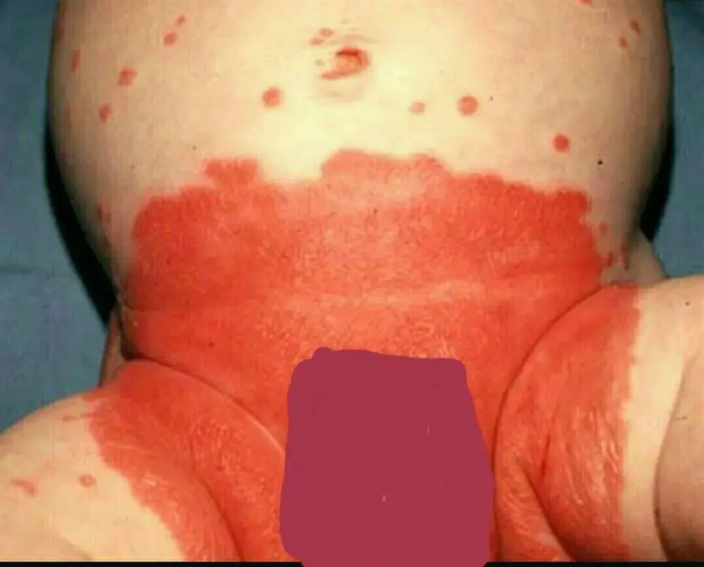  سوختگی پای نوزاد در فرم آلرژیک نیز که بیشتر به رنگ های موجود در پوشک و یا حتی آلرژی نسبت به مواد شیمیایی و رزینهای موجود در پوشک رخ می دهد