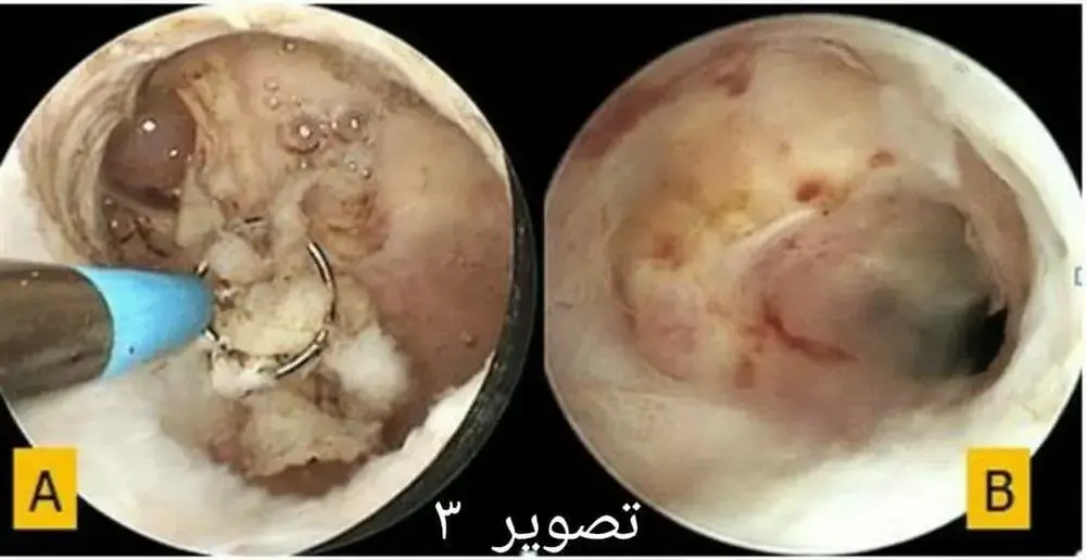 ظاهر CSD هیستروسکوپی (A) در هنگام برداشتن بافت فیبروتیک و (B) پس از پیگیری 6 ماهه