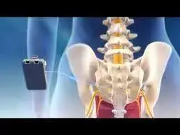  الکترودهای موقتا به رکتوم یا واژن وارد می شوند تا عضلات کف لگن را تحریک و تقویت کنند. 