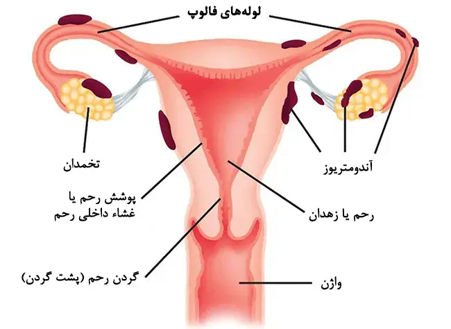  اندومتریوز زمانی اتفاق می افتد که لایه بافت رحم خارج از رحم رشد می کند 