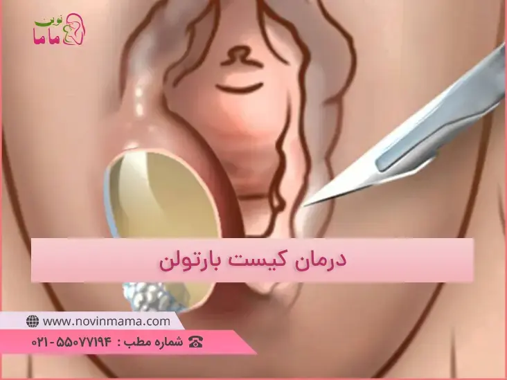 درمان کیست بارتولن روش های مختلفی دارد که شامل جراحی، جراحی با کاتتر فولی، آنتی بیوتیک و ... می شود.