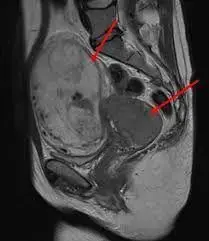 MRI