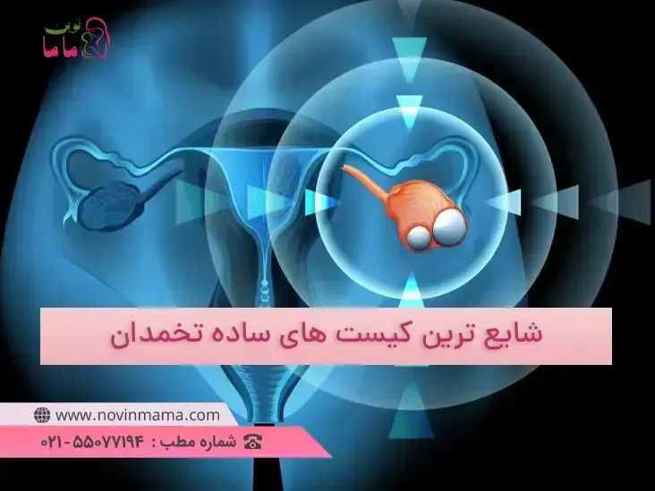 شایع ترین کیست های ساده تخمدان