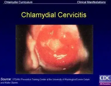 Trichomonas vaginalis که عموما سبب عفونت های واژینال می شود در بحث سرویسیت وارد است.