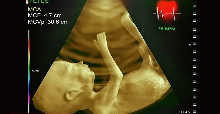 اکوکاردیوگرافی جنینی