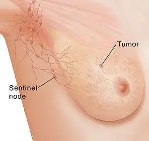 غده های لنفاوی (لنف نودز Lymph nodes) اندامهای تقریبا گِرد کوچکی هستند که بخشی از دستگاه لنفاوی بدن محسوب میشوند.