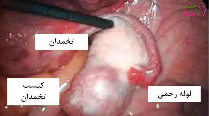 آیا ترکیبی از لتروزول و کلومیفن سیترات (CC) منجر به تخمک گذاری بالاتر از لتروزول به تنهایی در زنان نابارور مبتلا به سندرم تخمدان پلی کیستیک (PCOS) است.