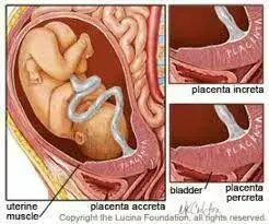 PLACENTA ACCRETAدر این حالت جفت شدیدا به میومتر رحم چسبندگی دارد ولی به داخل میومتر نفوذ ندارد